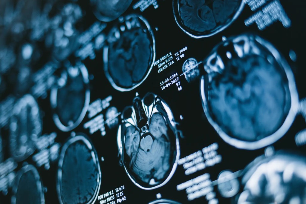 MRI brain scans on a medical imaging display at an interventional radiology clinic in Denver